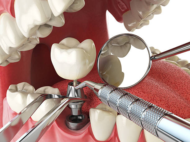 Best Emergency Wisdom Teeth Removal in Springdale, OH
