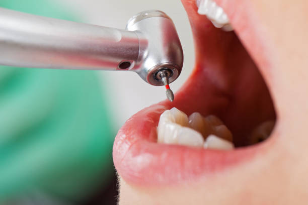 Best Emergency Gum Treatment in Springdale, OH